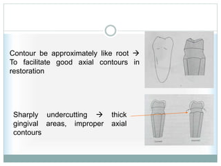 Contour be approximately like root 
To facilitate good axial contours in
restoration
Sharply undercutting  thick
gingival areas, improper axial
contours
 