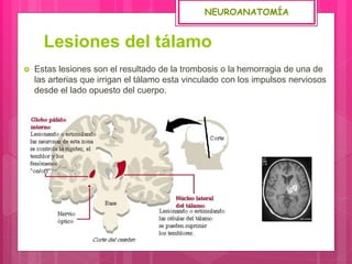 Lesiones del tálamo
 Estas lesiones son el resultado de la trombosis o la hemorragia de una de
las arterias que irrigan el tálamo esta vinculado con los impulsos nerviosos
desde el lado opuesto del cuerpo.
NEUROANATOMÍA
 