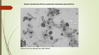 Smear hematoxilina férrica mostrando trofozoítos pleomórficos.

Johnson E H et al. Clin. Microbiol. Rev. 2004;17:553-570

 
