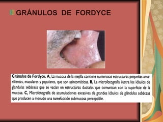 GRÁNULOS  DE  FORDYCE 