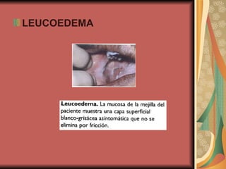 LEUCOEDEMA 