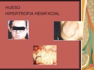 HUESO HIPERTROFIA HEMIFACIAL 