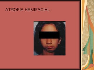 ATROFIA HEMIFACIAL 