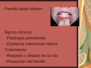 Frenillo labial inferior:  Signos clínicos: -Patología periodontal -Diastema interincisal inferior  Tratamiento:  -Raspado y alisado de la raiz -Resección del frenillo  