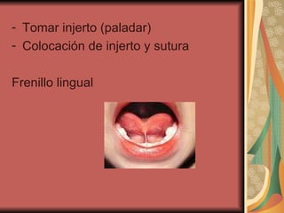 Tomar injerto (paladar) Colocación de injerto y sutura Frenillo lingual 