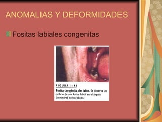ANOMALIAS Y DEFORMIDADES Fositas labiales congenitas 