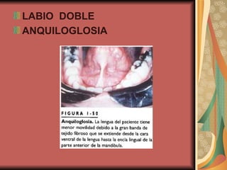 LABIO  DOBLE ANQUILOGLOSIA 