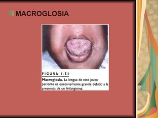 MACROGLOSIA 