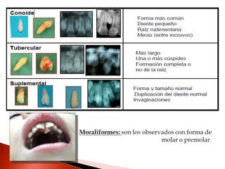 Dientes supernumerarios | PPS