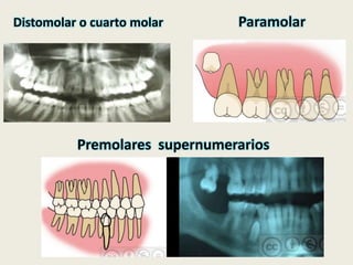 Distomolar o cuarto molar Paramolar 
Premolares supernumerarios 
 