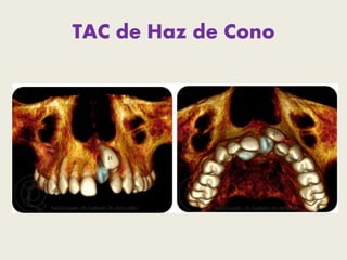 TRATAMIENTO 
“Todo diente supernumerario incluido que de 
clínica debe ser exodonciado” 
• La indicación de extracción vie...