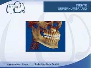DIENTE
SUPERNUMERARIO
www.dentometric.com Dr. Enrique Sierra Rosales
 