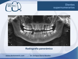 Radiografía panorámica
www.dentometric.com Dr. Enrique Sierra Rosales
Dientes
supernumerarios
 