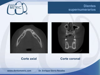 Corte axial
www.dentometric.com Dr. Enrique Sierra Rosales
Dientes
supernumerarios
Corte coronal
 