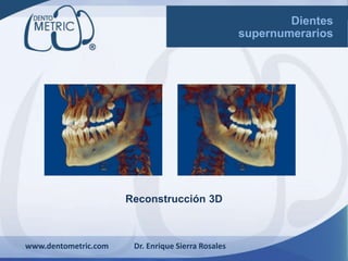 Reconstrucción 3D
www.dentometric.com Dr. Enrique Sierra Rosales
Dientes
supernumerarios
 