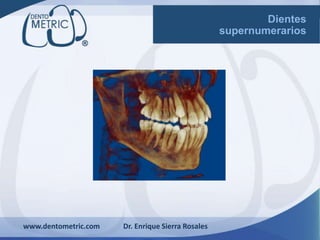 www.dentometric.com Dr. Enrique Sierra Rosales
Dientes
supernumerarios
 