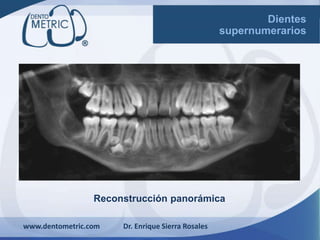 Reconstrucción panorámica
www.dentometric.com Dr. Enrique Sierra Rosales
Dientes
supernumerarios
 