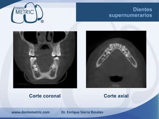 Corte coronal
www.dentometric.com Dr. Enrique Sierra Rosales
Dientes
supernumerarios
Corte axial
 