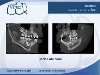 Cortes oblicuos
www.dentometric.com Dr. Enrique Sierra Rosales
Dientes
supernumerarios
 