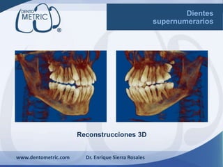 Reconstrucciones 3D
www.dentometric.com Dr. Enrique Sierra Rosales
Dientes
supernumerarios
 