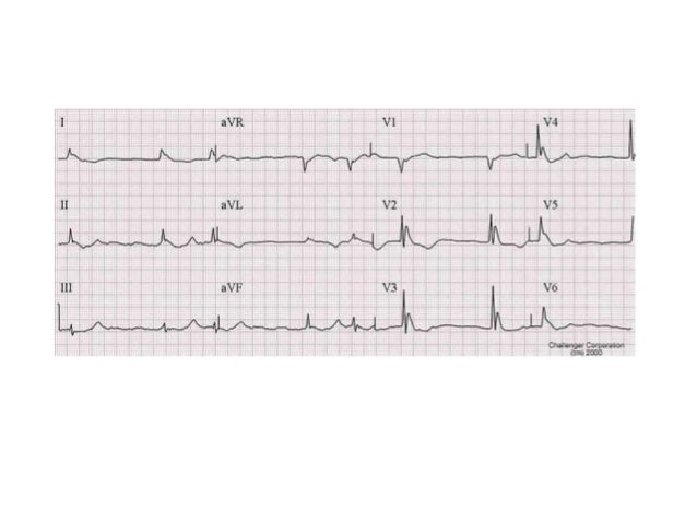 borderline-ekg-nedir-jafnorth