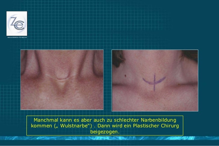 Wo man die Operation nach der Varikose machen kann