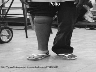 Polio




http://www.flickr.com/photos/cambodiatrust/2734163173
 