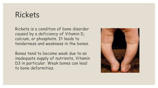Rickets Graph Diet and nutrition in newborn and kids | PPTX