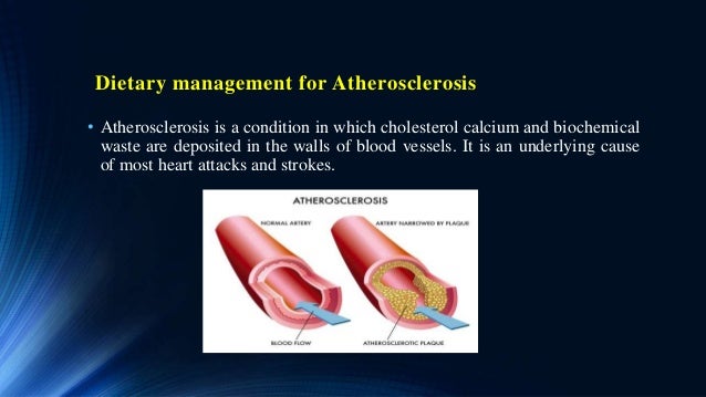 Dietary management for atherosclerosis Dietary management for atherosclerosis