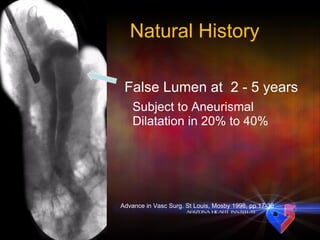Natural History False Lumen at  2 - 5 years Subject to Aneurismal Dilatation in 20% to 40%  Advance in Vasc Surg. St Louis, Mosby 1998, pp 17-36 