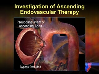 Investigation of Ascending Endovascular Therapy Bypass Occluded Pseudoaneurysm of Ascending Aorta 