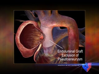 Endoluminal Graft Exclusion of Pseudoaneurysm 