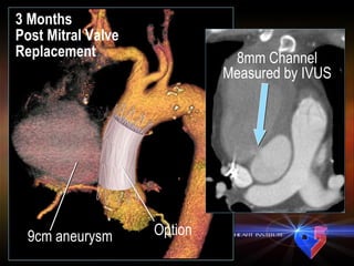 3 Months  Post Mitral Valve Replacement 9cm aneurysm 8mm Channel Measured by IVUS Option 