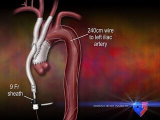 240cm wire to left iliac artery 9 Fr  sheath 