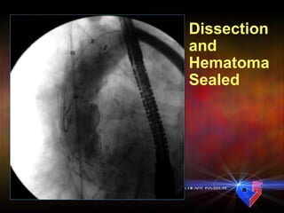 Dissection and Hematoma Sealed 