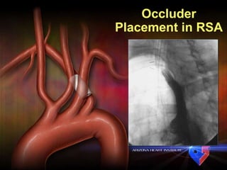 Occluder Placement in RSA 