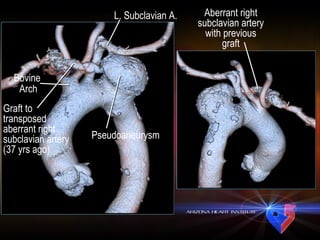 L. Subclavian A. Bovine  Arch Graft to transposed aberrant right subclavian artery (37 yrs ago) Pseudoaneurysm Aberrant right subclavian artery with previous graft 