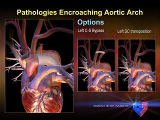 Pathologies Encroaching Aortic Arch Options Left C-S Bypass Left SC transposition 