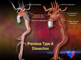 Previous Type A Dissection Aberrant right subclavian artery Left CCA dissection Distal arch dissection False channel expansion Left subclavian  dissection Left CCA dissection 