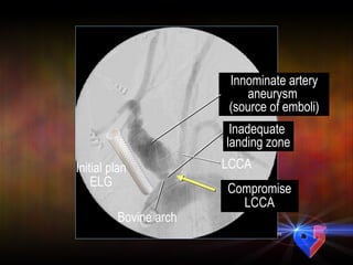 Bovine arch Initial plan ELG Innominate artery aneurysm  (source of emboli) Inadequate  landing zone LCCA Compromise LCCA 