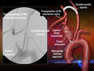 Coiled  aneurysm Transposition of Rt.  subclavian artery  Carotid-carotid  bypass Coiled  aneurysm Transposition of Rt.  subclavian artery  Carotid-carotid  bypass Ligation  distal innominate Retrograde femoral approach 