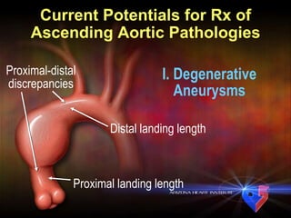 Current Potentials for Rx of Ascending Aortic Pathologies I. Degenerative Aneurysms Proximal landing length Distal landing length Proximal-distal discrepancies 