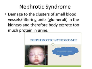 Nephrotic Syndrome
• Damage to the clusters of small blood
vessels/filtering units (glomeruli) in the
kidneys and therefore body excrete too
much protein in urine.
 