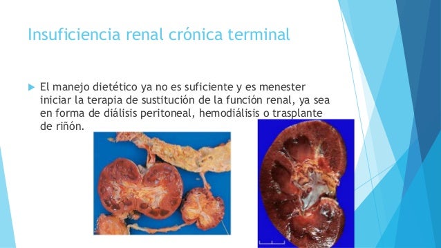 Insuficiencia renal fase terminal Insuficiencia renal fase terminal