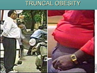 TRUNCAL OBESITYTRUNCAL OBESITY
 