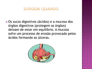  Os

sucos digestivos (ácidos) e a mucosa dos
órgãos digestivos (protegem os órgãos)
deixam de estar em equilíbrio. A mucosa
sofre um processo de erosão provocado pelos
ácidos formando as úlceras.

 