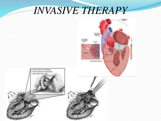 treatment of hypertrophy cardiomyopathy