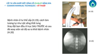 Điều Trị Đau Cột Sống Mạn Tính bằng Sóng Vô Tuyến Cao Tần RFA (Rafio ...