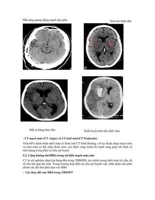Dấu tăng quang động mạch não giữa
- CT mạch máu (CT Angio) và CT tưới máu(CT Perfusoin):
Trên 60% bệnh nhân nhồi máu có hình ảnh CT bình thường, với kỷ thuật chụp mạch máu
và tưới máu có thể chẩn đoán sớm, xác định vùng tranh tối tranh sáng giúp chỉ định và
tiên lượng trong điều trị tiêu sợi huyết.
5.2. Cộng hƣởng từ(MRI) trong tai biến mạch máu não
CT là xét nghiệm chọn lựa hàng đầu trong TBMMN, tuy nhiên trong nhồi máu tối cấp, đa
số cho kết quả âm tính. Trong trường hợp điều trị tiêu sợi huyết việc chẩn đoán cần phải
chính xác đòi hỏi phải dựa vào MRI
- Các thay đổi của MRI trong TBMMN
Xuất huyết trên nền nhồi máuMất ru băng thùy đảo
Xóa mờ nhân đậu
 