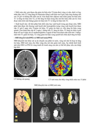 + Nhồi máu não: giai đọan cấp giảm tín hiệu trên T1(màu đen) vùng vỏ não, dưới vỏ hay
nhân đậu, trên T2 vùng tăng tín hiệu(màu trắng) xuất hiện sau 8 giờ, hiệu ứng choáng chổ
sau 24 giờ và không bắt chất cản từ. Giai đọan bán cấp(sau một tuần) giảm tín hiệu trên
T1 và tăng tín hiệu trên T2, có thể tăng tín hiệu trong nhu mô khi tiêm chất cản từ. Giai
đoạn mãn (trên một tháng) giảm tín hiệu trên T1 và tăng tín hiệu trên T2.
+ Xuất huyết não: rất khó phân biệt nhồi máu hay xuất huyết trong giai đoạn sớm, MRI
phát hiện được tổn thương xuất huyết nhờ hemoglobin trong vùng xuất huyết.Giai đọan
cấp 12 giờ-2 ngày trên T1giảm tín hiệu, T2 giảm tín hiệu có viền tăng tín hiệu xung
quanh. Giai đoạn bán cấp từ 3 ngày-1 tháng trên T1 tăng tín hiệu, T2 tăng tín hiệu ở giai
đoạn trễ sau 8 ngày do có methemoglobin ở ngoài tế bào.Giai đoạn mãn tính trên 1 tháng-
năm trên T1 giảm tín hiệu, T2 vùng giảm tín hiệu xung quanh kén chứa dịch tăng tín hiệu
- MRI khuyếch tán(DWI) và MRI tưới máu(PWI)
MRI khuyếch tán khảo sát sự di chuyển của phân tử nước, vùng mô não bị hoại tử tăng
tín hiệu, MRI tưới máu cho thấy vùng nhu mô não giảm tưới máu. Sự chênh lệch hình
ảnh trên DWI và PWI là vùng tranh tối tranh sáng của não có thể hồi phục nếu can thiệp
kịp thời.
CT không cản quang
MRI khuyếch tán và MRI tưới máu
CT tưới máu cho thấy vùng thiếu máu sau 15 phút
Cấp
Sau 3 ngày
- Lõi họai tử
- Vùng tranh
tối tranh sáng
 